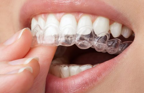 young woman holding whitening tray with gel. home teeth whitening procedure